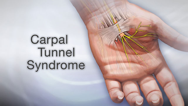 Carpal Tunnel Syndrome kalra brain and spine