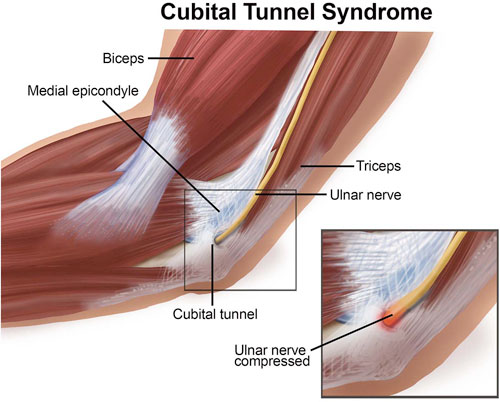 Cubital Tunnel Syndrome kalra brain and spine